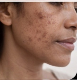 hyperpigmentierte Haut hyperpigmentierte Haut