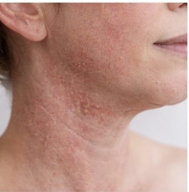 athopische Haut athopische Haut